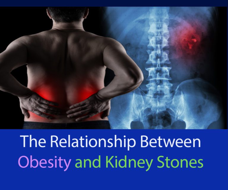 The Relationship Between Obesity and Kidney Stones